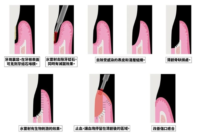 牙周治療 牙周治療